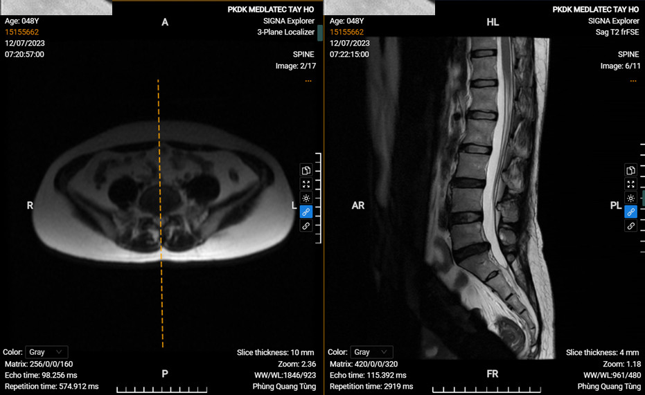 Phác đồ điều trị thoát vị đĩa đệm cột sống thắt lưng bằng kết hợp sóng ngắn, xoa bóp bấm huyệt, điện châm và kéo giãn cột sống