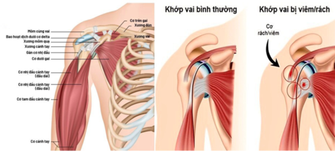 Điều trị bệnh lý viêm quanh khớp vai tại Trung tâm Nhiệt đới Việt-Nga